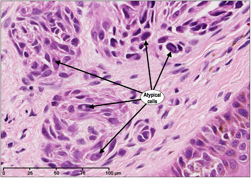 basal cell carcinoma histology #10