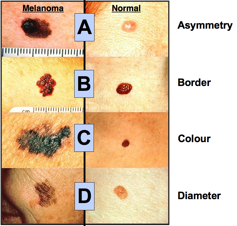 superficial spreading malignant melanoma